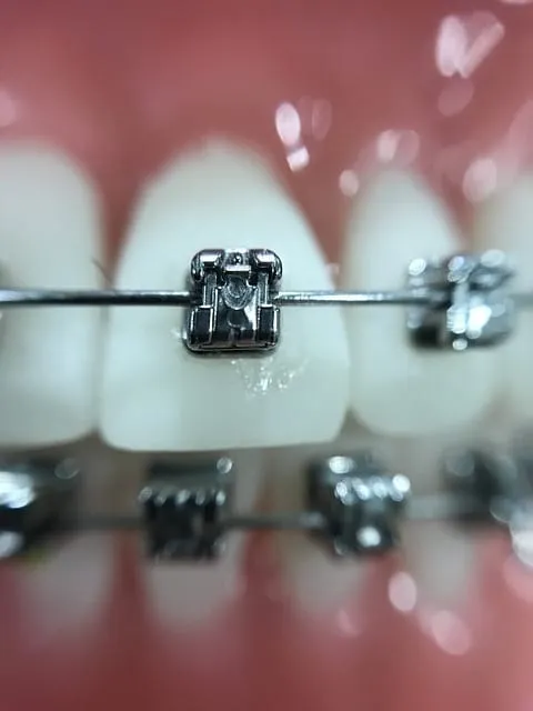 Close de dentes com aparelho ortodôntico metálico